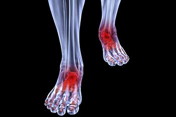 Arthritic Foot & Ankle Care