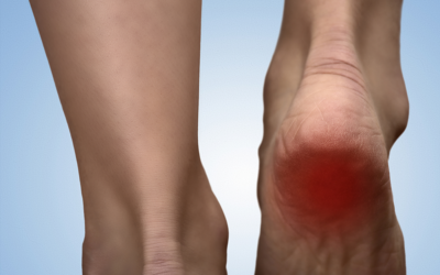 Heel Pain When Walking? Find Treatment Today