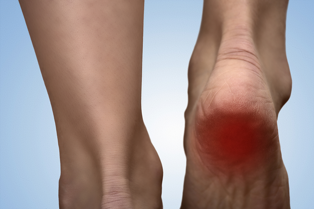 Heel Pain When Walking? Find Treatment Today