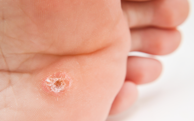 Plantar Wart vs. Callus: How to Tell the Difference