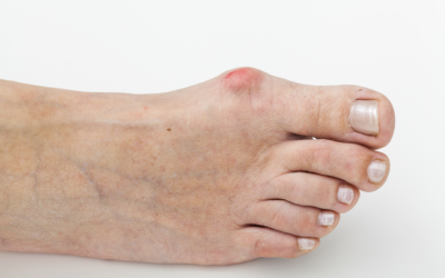 How Can You Fix Bunions Without Surgery?