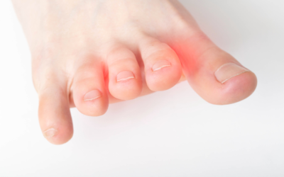 Will a Neuroma Go Away on Its Own?