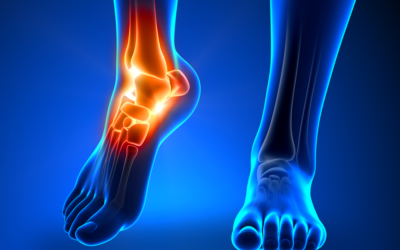 8 Things You Can Do to Relieve Arthritic Ankle Pain